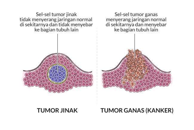 Apa Bedanya Tumor Dan Kanker Versus Beda